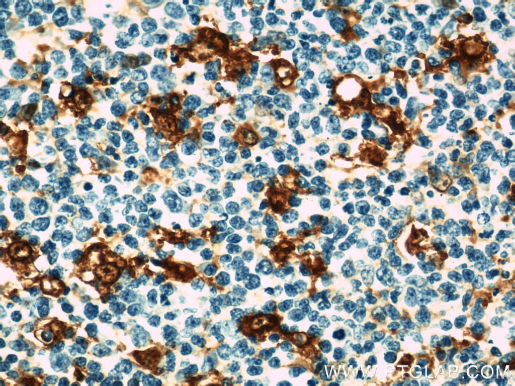 IHC staining of human tonsillitis using 10194-1-AP