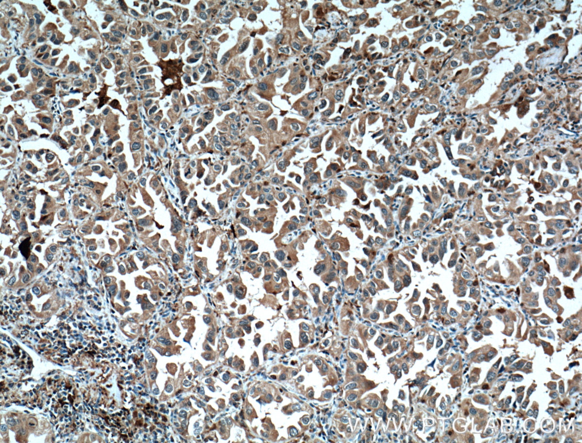 Immunohistochemistry (IHC) staining of human lung cancer tissue using CAPG Monoclonal antibody (66277-1-Ig)