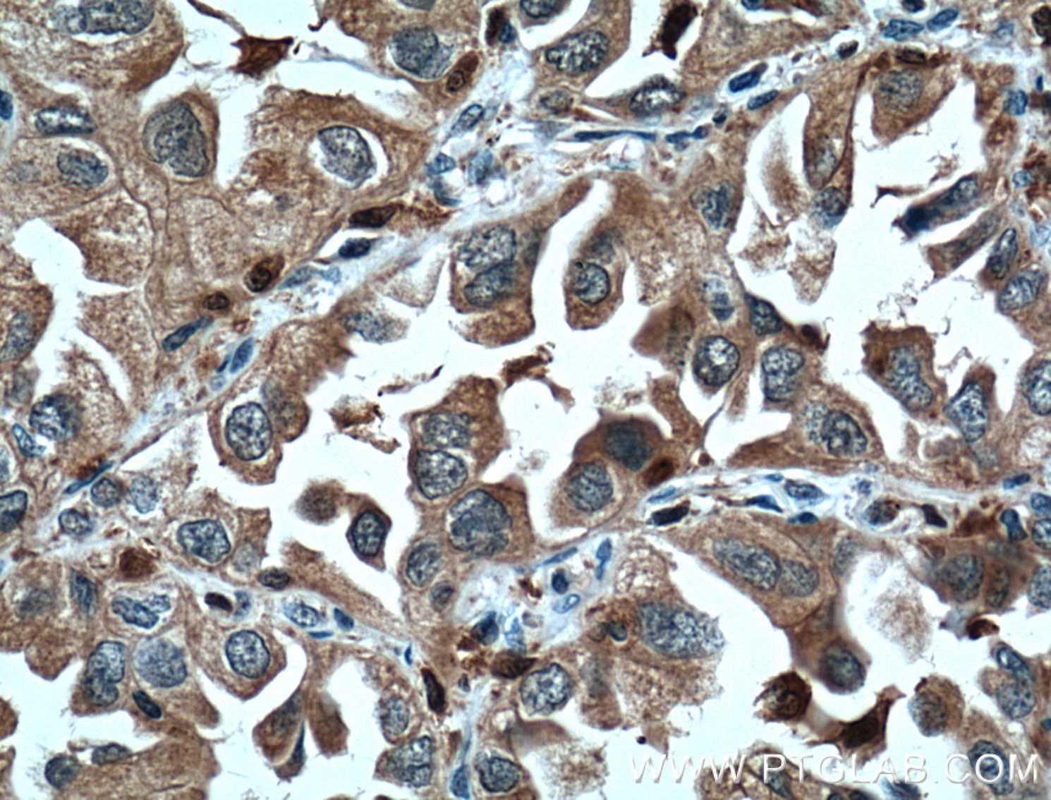 Immunohistochemistry (IHC) staining of human lung cancer tissue using CAPG Monoclonal antibody (66277-1-Ig)