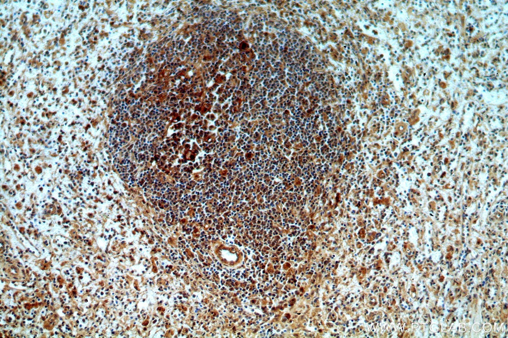 Immunohistochemistry (IHC) staining of human spleen tissue using CAPG-Specific Polyclonal antibody (19535-1-AP)