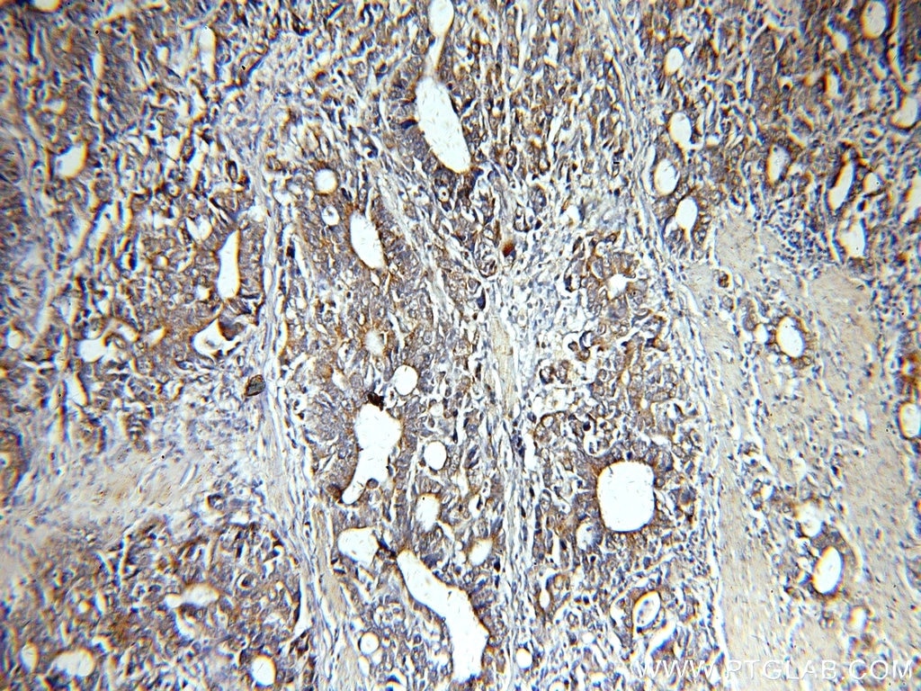 Immunohistochemistry (IHC) staining of human stomach cancer tissue using CAPG-Specific Polyclonal antibody (19535-1-AP)