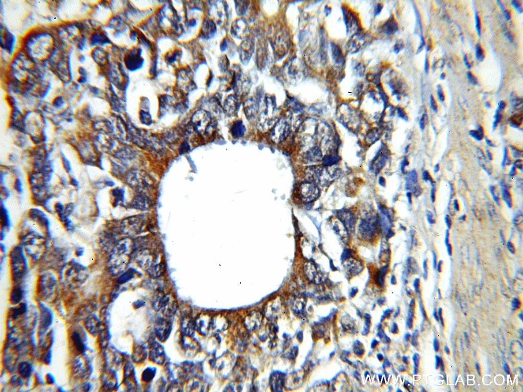 Immunohistochemistry (IHC) staining of human stomach cancer tissue using CAPG-Specific Polyclonal antibody (19535-1-AP)