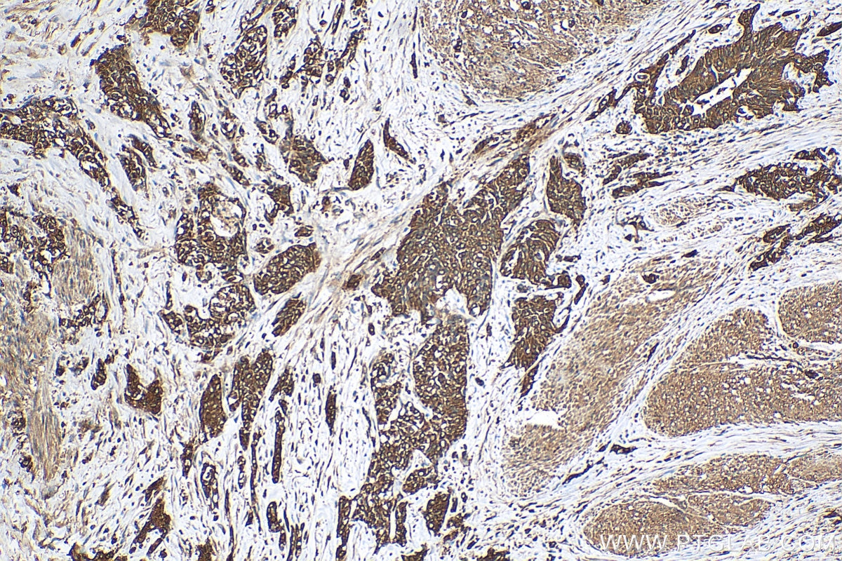 Immunohistochemistry (IHC) staining of human urothelial carcinoma tissue using Calpain 1 Polyclonal antibody (10538-1-AP)