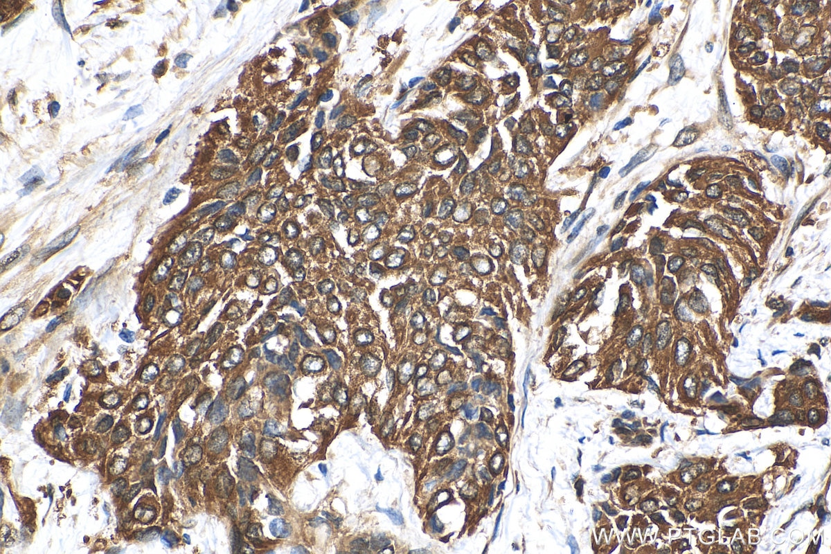 IHC staining of human urothelial carcinoma using 10538-1-AP