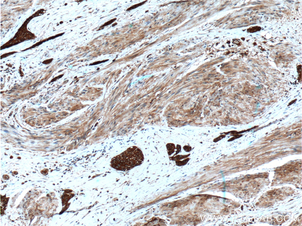 Immunohistochemistry (IHC) staining of human urothelial carcinoma tissue using Calpain 1 Polyclonal antibody (10538-1-AP)