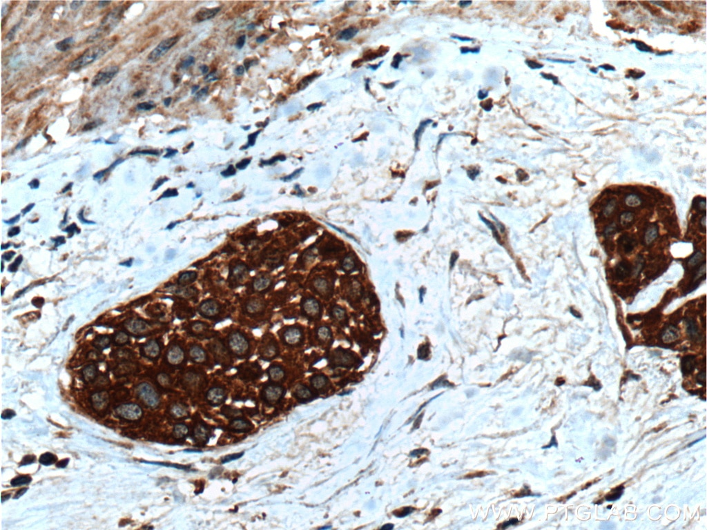 Immunohistochemistry (IHC) staining of human urothelial carcinoma tissue using Calpain 1 Polyclonal antibody (10538-1-AP)