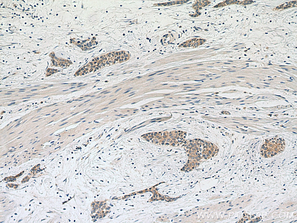 Immunohistochemistry (IHC) staining of human urothelial carcinoma tissue using CAPN1 Monoclonal antibody (67732-1-Ig)