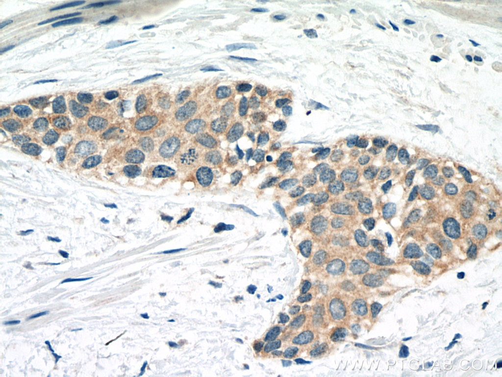 Immunohistochemistry (IHC) staining of human urothelial carcinoma tissue using CAPN1 Monoclonal antibody (67732-1-Ig)