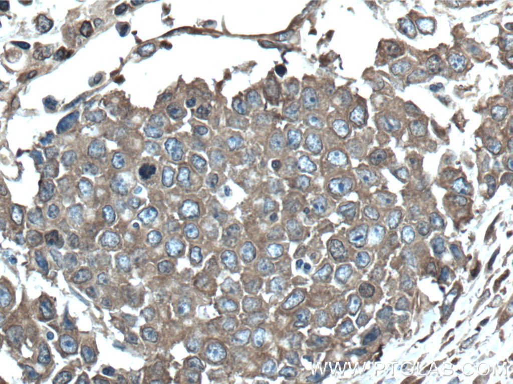Immunohistochemistry (IHC) staining of human colon cancer tissue using Calpain 2 Polyclonal antibody (11472-1-AP)