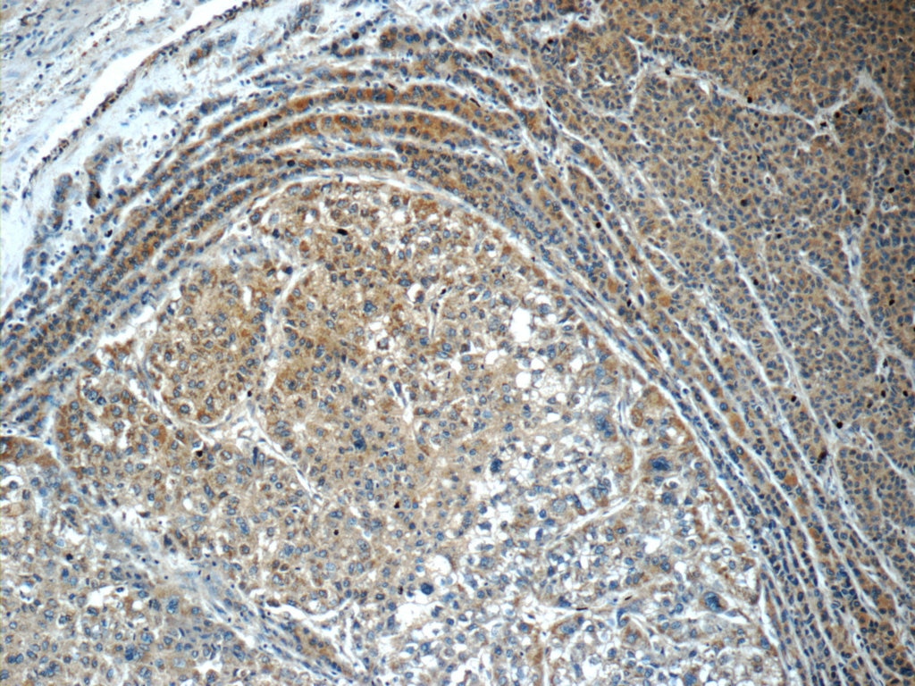 Immunohistochemistry (IHC) staining of human liver cancer tissue using Calpain 2 Polyclonal antibody (11472-1-AP)