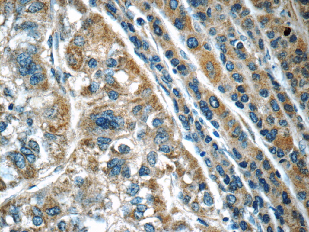 Immunohistochemistry (IHC) staining of human liver cancer tissue using Calpain 2 Polyclonal antibody (11472-1-AP)