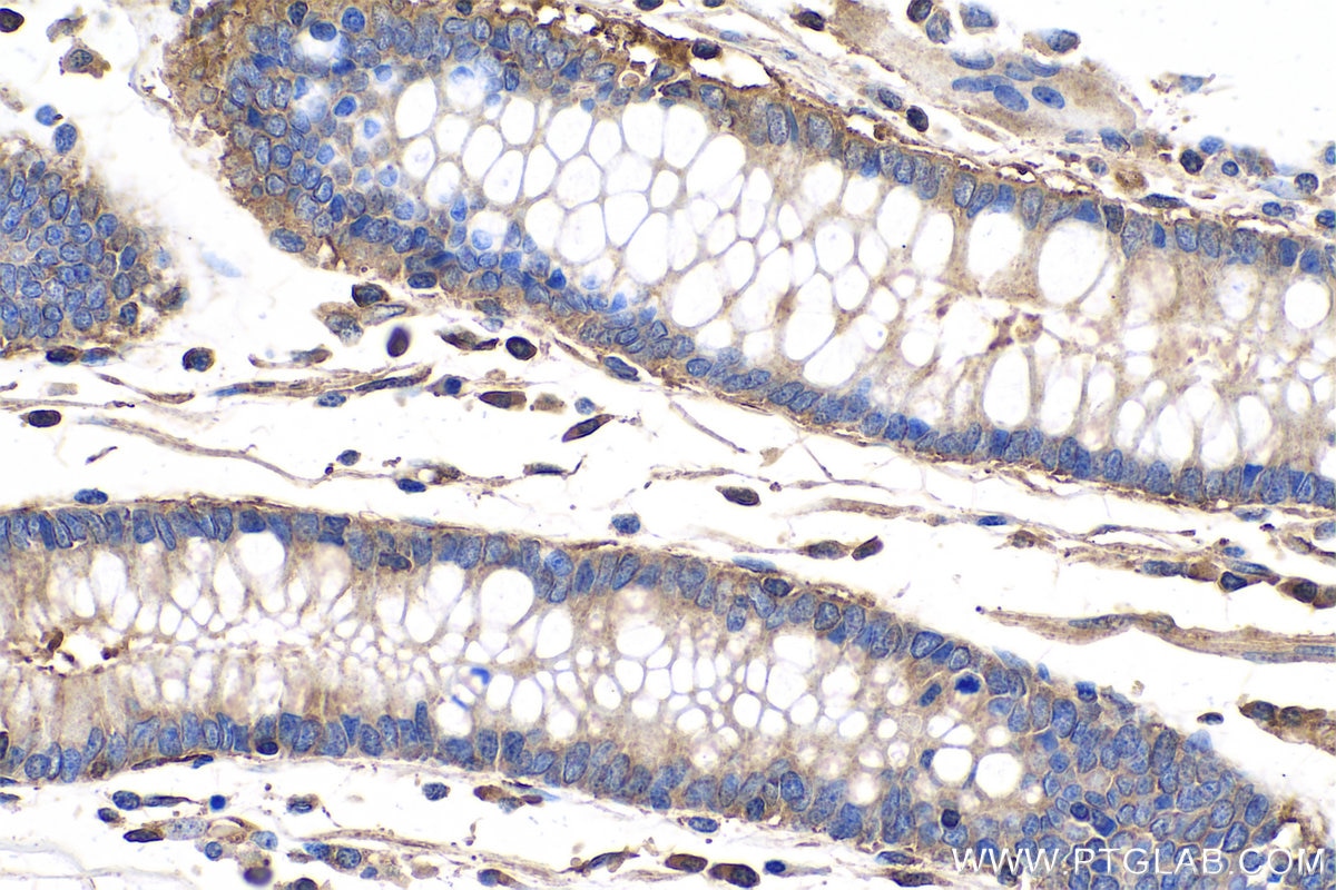 Immunohistochemistry (IHC) staining of human stomach cancer tissue using CAPN2 Monoclonal antibody (66977-1-Ig)