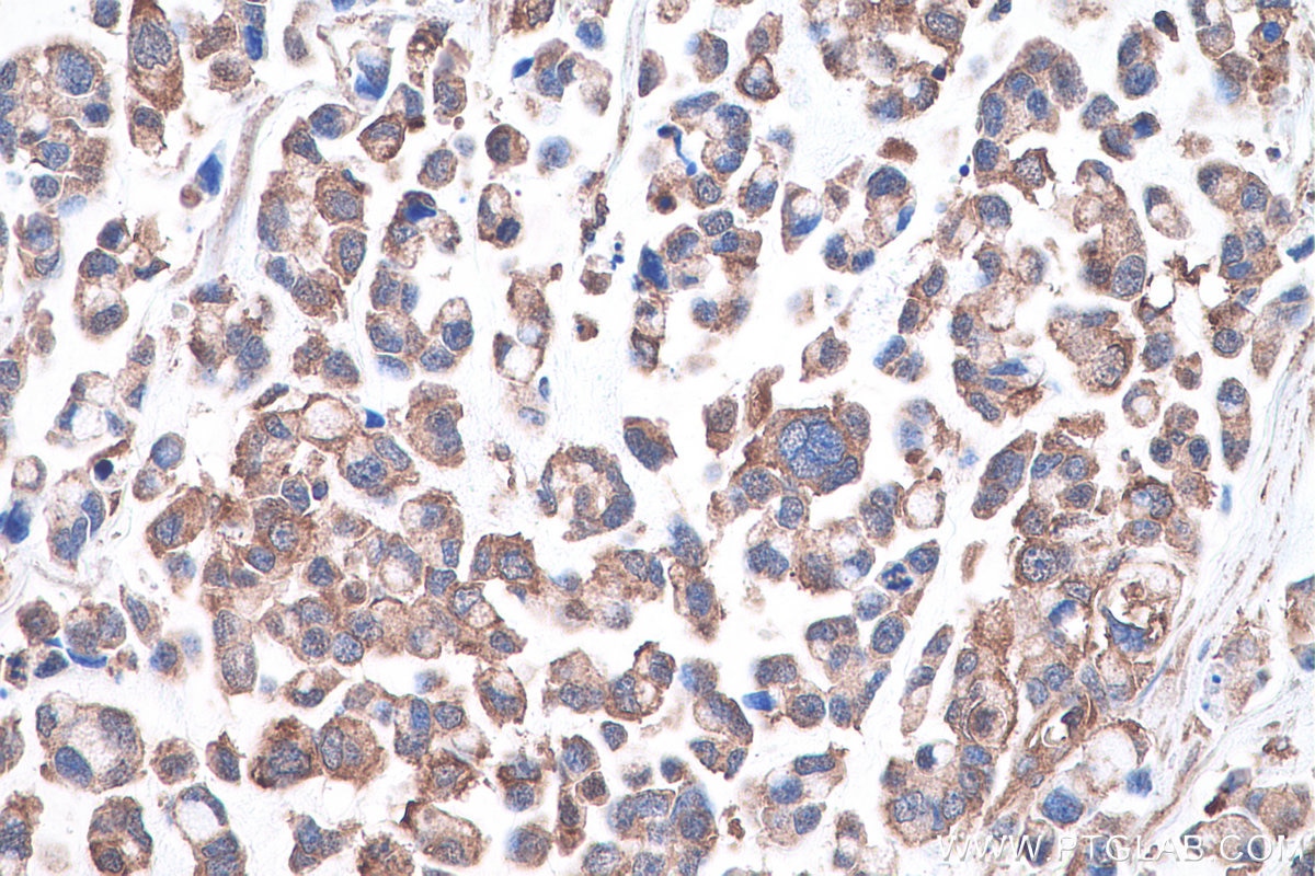 Immunohistochemistry (IHC) staining of human colon cancer tissue using CAPN2 Monoclonal antibody (66977-1-Ig)