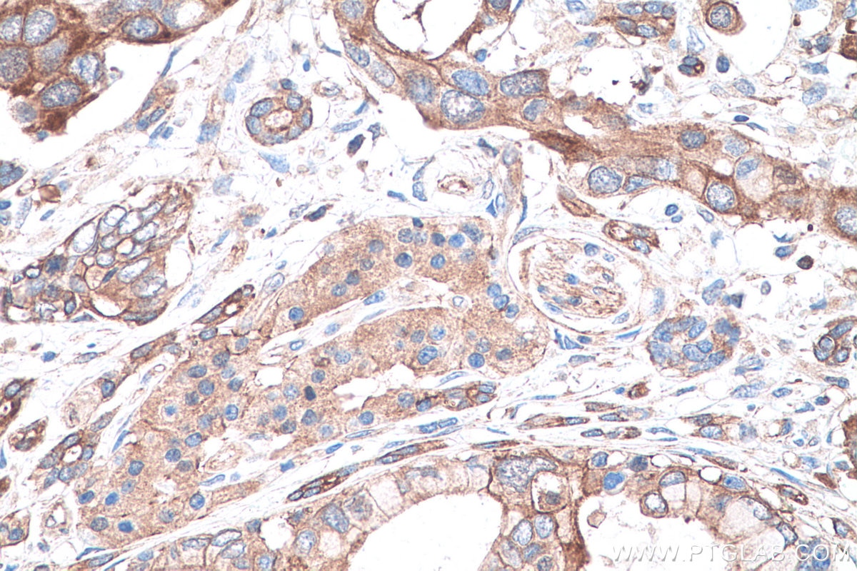 Immunohistochemistry (IHC) staining of human pancreas cancer tissue using CAPN2 Monoclonal antibody (66977-1-Ig)