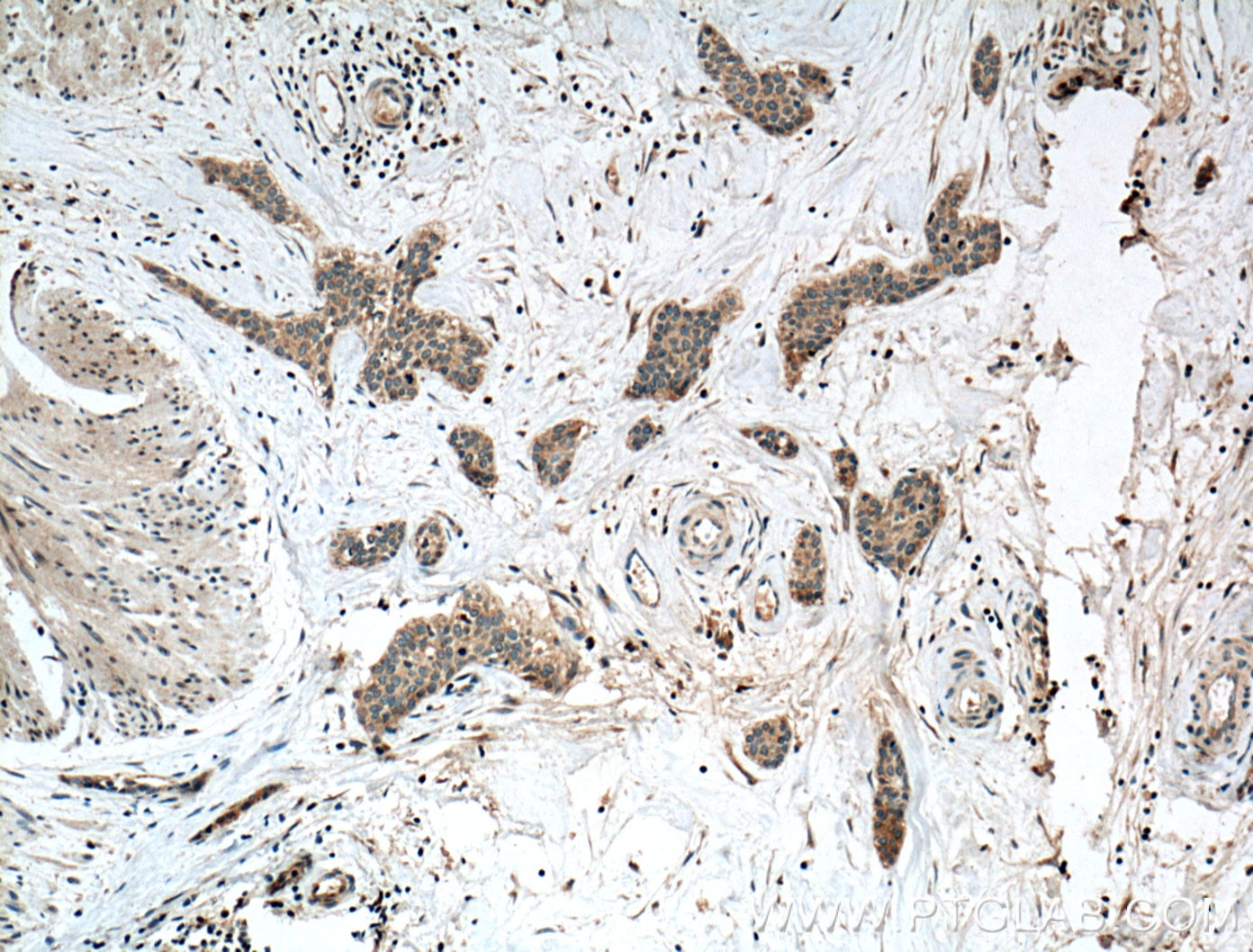 Immunohistochemistry (IHC) staining of human urothelial carcinoma tissue using Calpain 3 Polyclonal antibody (10415-1-AP)