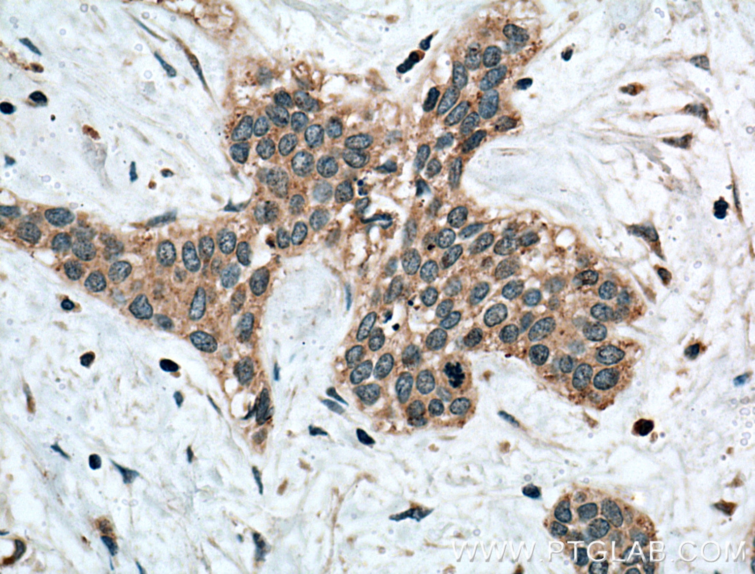 Immunohistochemistry (IHC) staining of human urothelial carcinoma tissue using Calpain 3 Polyclonal antibody (10415-1-AP)