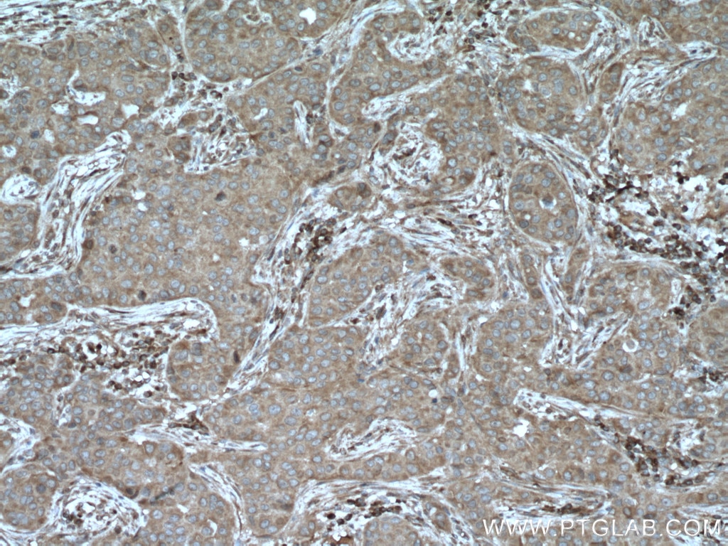 Immunohistochemistry (IHC) staining of human breast cancer tissue using Calpain 3 Polyclonal antibody (10492-1-AP)