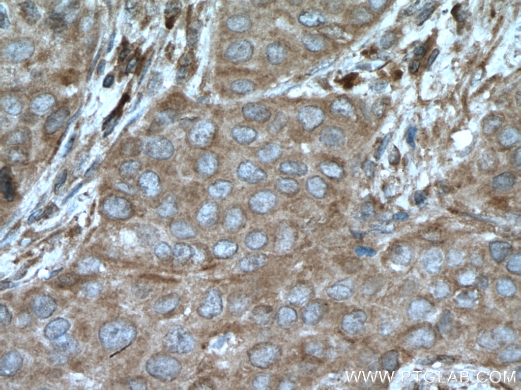 Immunohistochemistry (IHC) staining of human breast cancer tissue using Calpain 3 Polyclonal antibody (10492-1-AP)