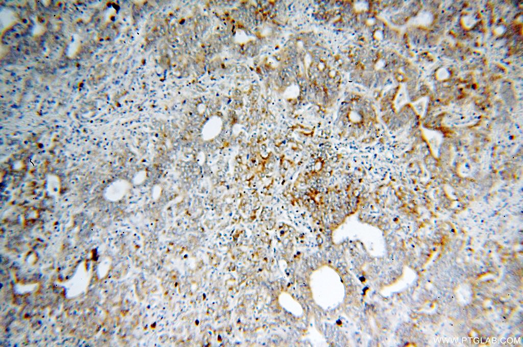 Immunohistochemistry (IHC) staining of human stomach cancer tissue using Calpain 9 Polyclonal antibody (17556-1-AP)