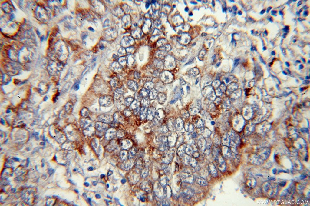 Immunohistochemistry (IHC) staining of human stomach cancer tissue using Calpain 9 Polyclonal antibody (17556-1-AP)