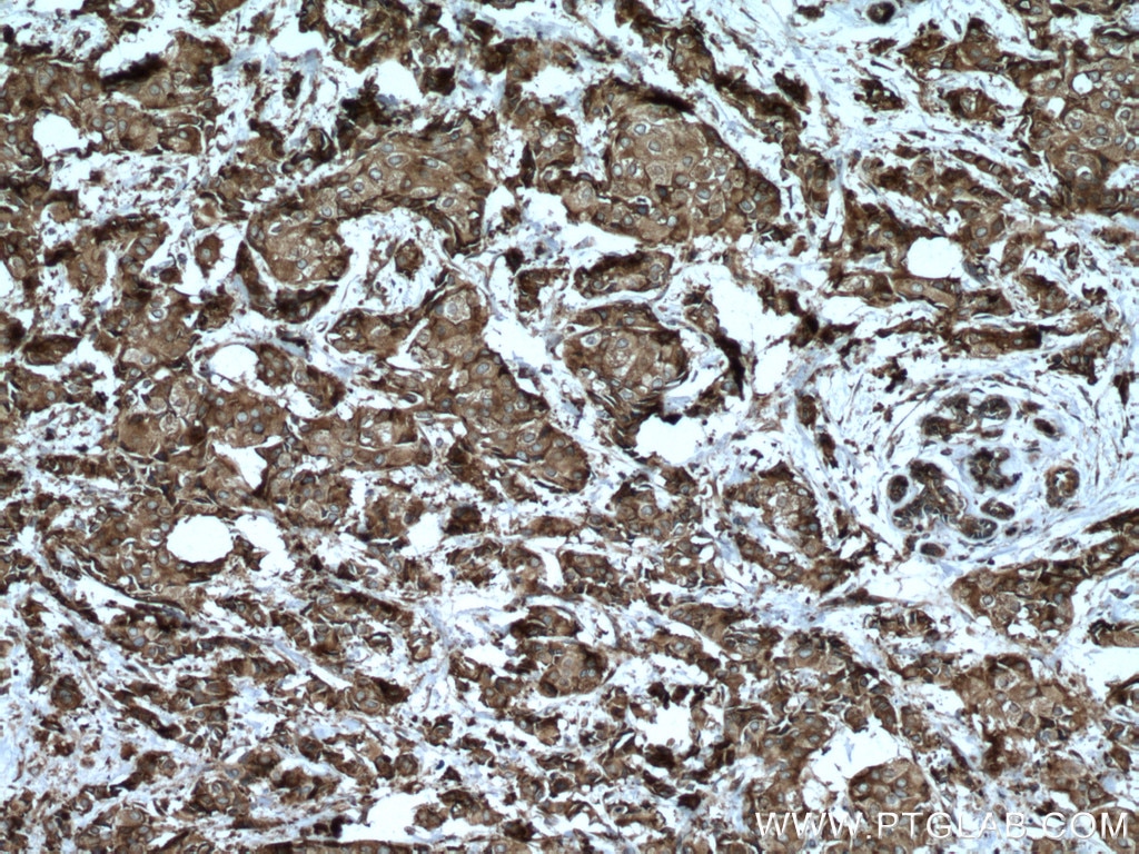 Immunohistochemistry (IHC) staining of human breast cancer tissue using CAPRIN1 Polyclonal antibody (15112-1-AP)