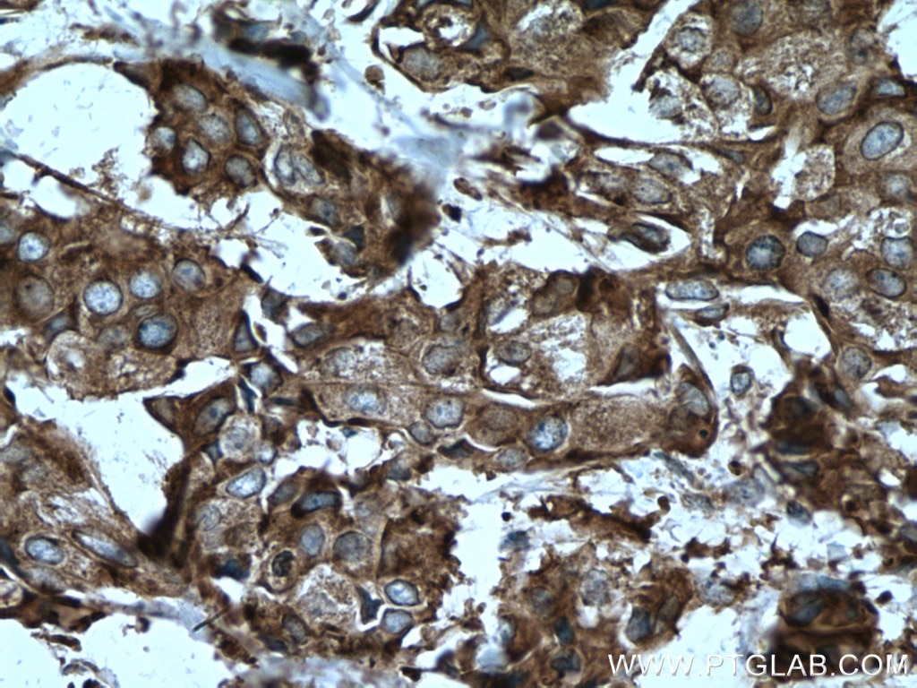 Immunohistochemistry (IHC) staining of human breast cancer tissue using CAPRIN1 Polyclonal antibody (15112-1-AP)