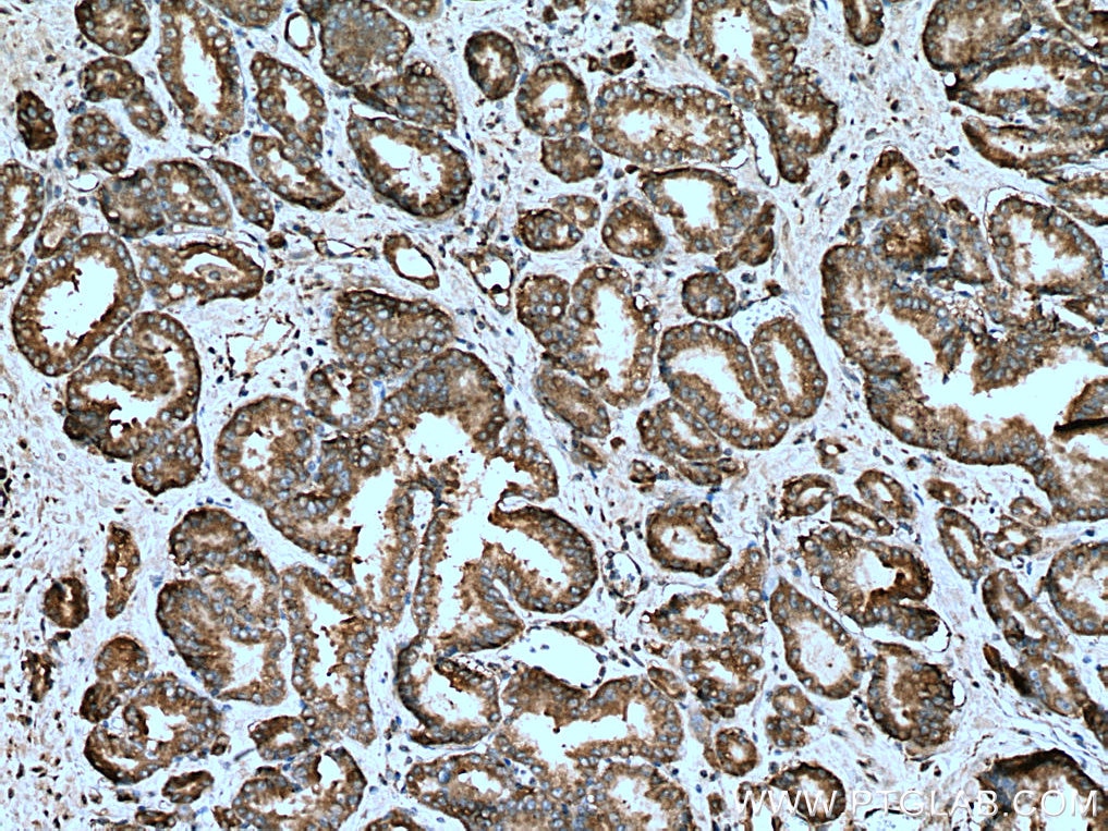 Immunohistochemistry (IHC) staining of human prostate cancer tissue using CAPRIN1 Polyclonal antibody (15112-1-AP)