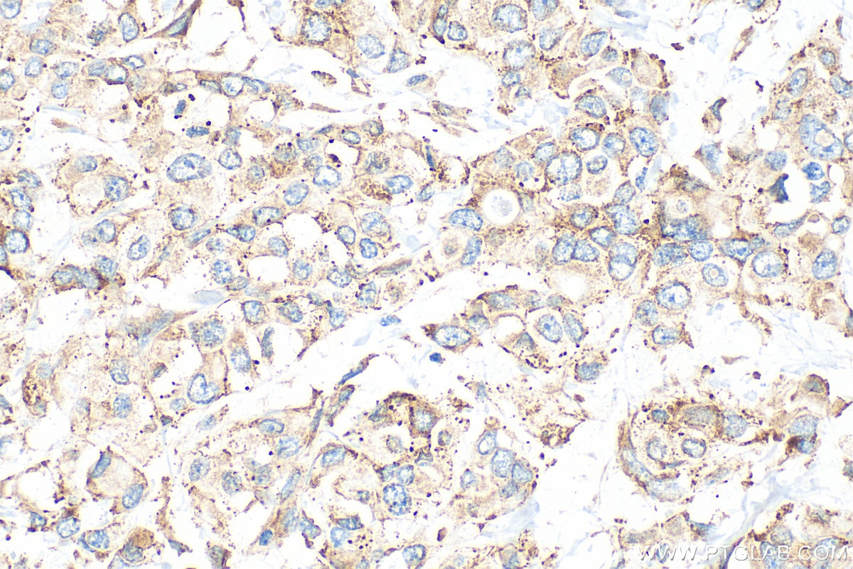 Immunohistochemistry (IHC) staining of human breast cancer tissue using CAPRIN1 Polyclonal antibody (15112-1-AP)