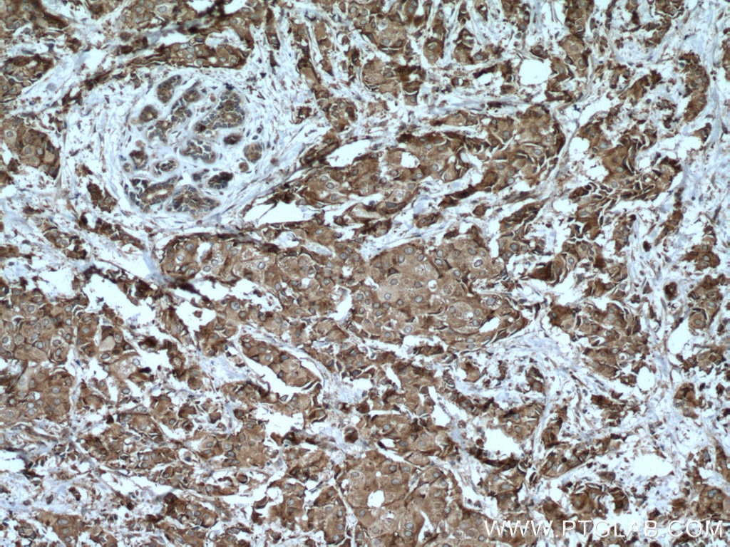 Immunohistochemistry (IHC) staining of human breast cancer tissue using CAPRIN1 Monoclonal antibody (66352-1-Ig)