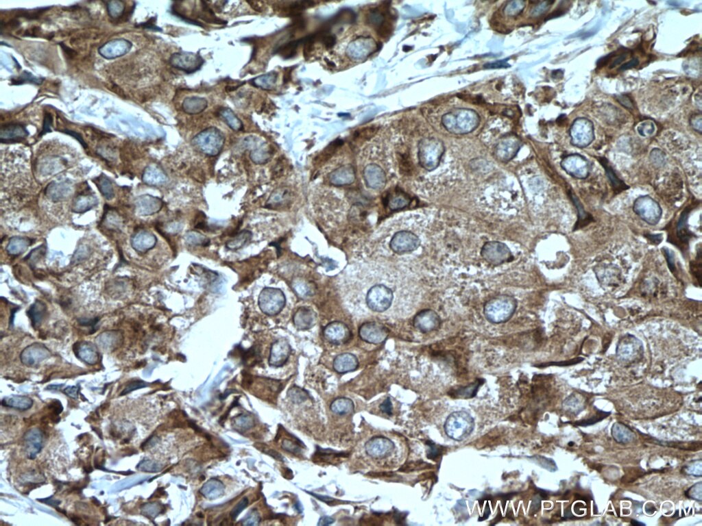 Immunohistochemistry (IHC) staining of human breast cancer tissue using CAPRIN1 Monoclonal antibody (66352-1-Ig)