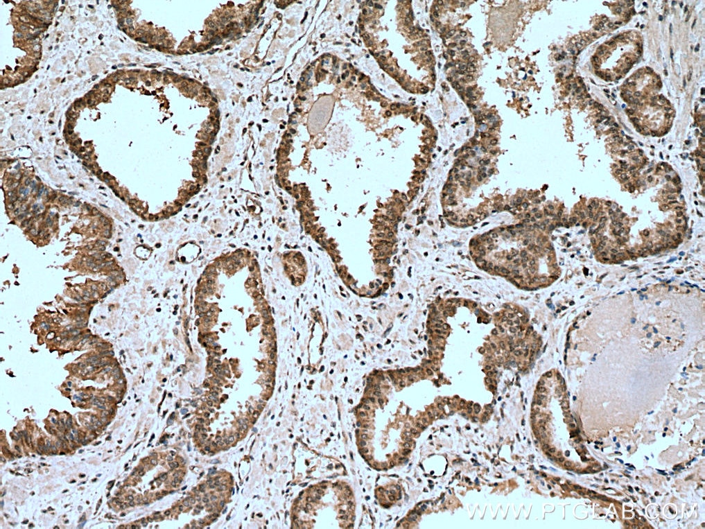 Immunohistochemistry (IHC) staining of human prostate cancer tissue using CAPRIN1 Monoclonal antibody (66352-1-Ig)