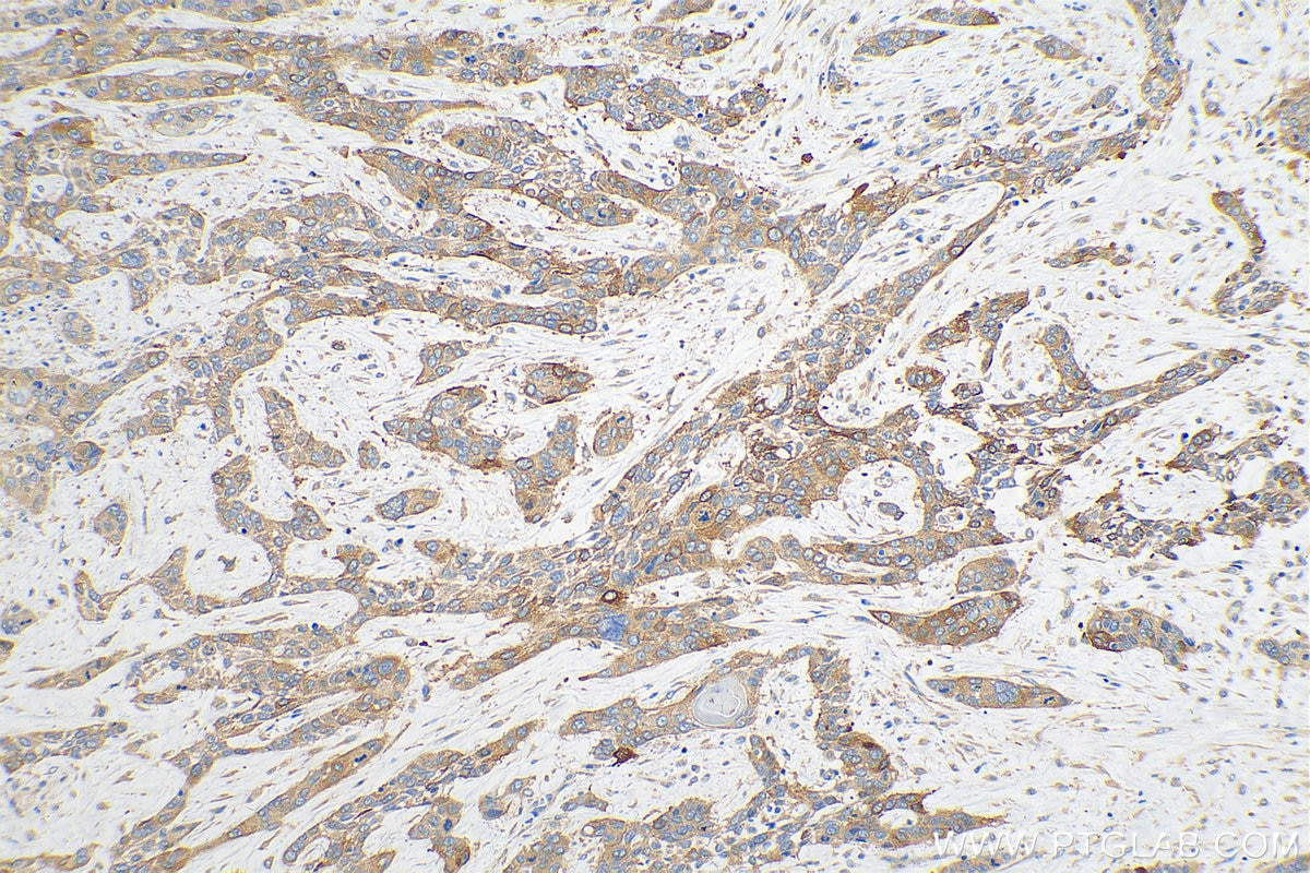 Immunohistochemistry (IHC) staining of human oesophagus cancer tissue using Calcyphosine Polyclonal antibody (16926-1-AP)