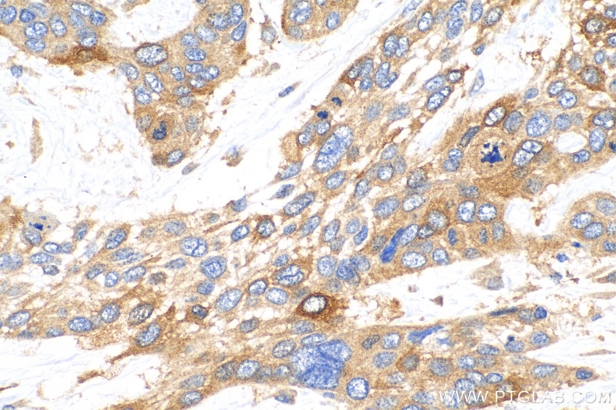 IHC staining of human oesophagus cancer using 16926-1-AP