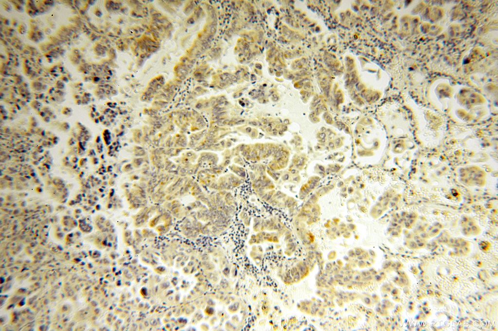 Immunohistochemistry (IHC) staining of human lung cancer tissue using CAPSL Polyclonal antibody (17174-1-AP)