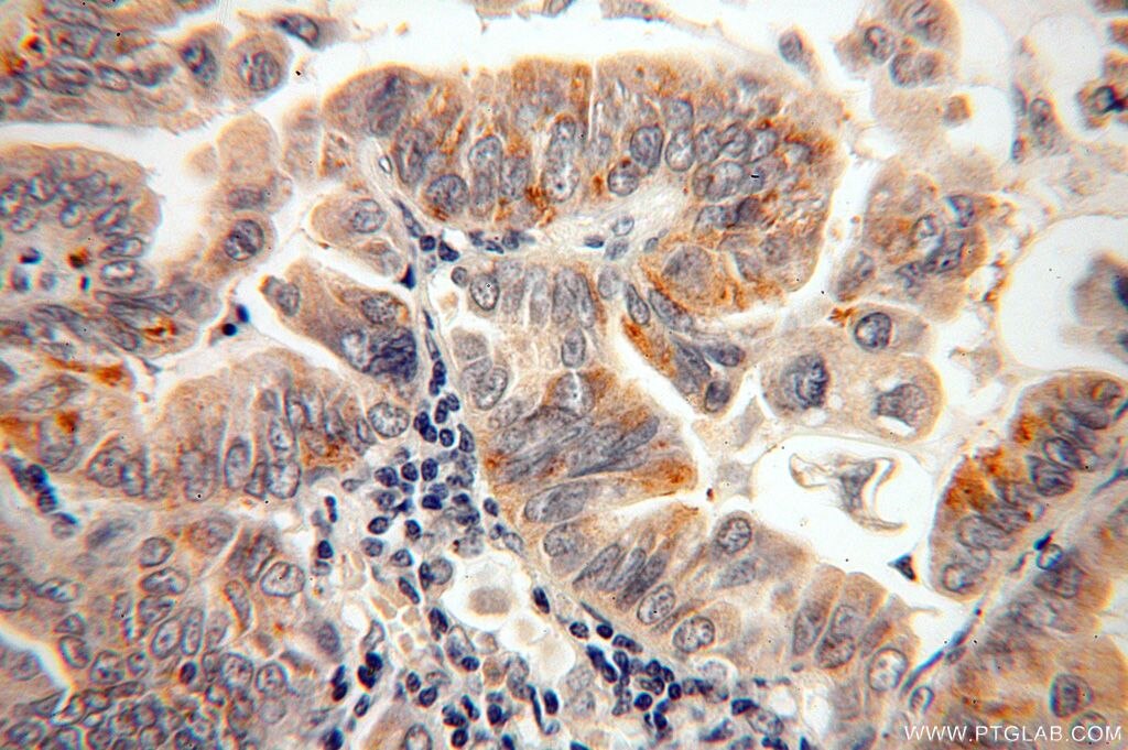 Immunohistochemistry (IHC) staining of human lung cancer tissue using CAPSL Polyclonal antibody (17174-1-AP)