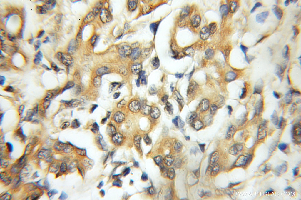 Immunohistochemistry (IHC) staining of human pancreas cancer tissue using CAPZA1 Polyclonal antibody (11806-1-AP)