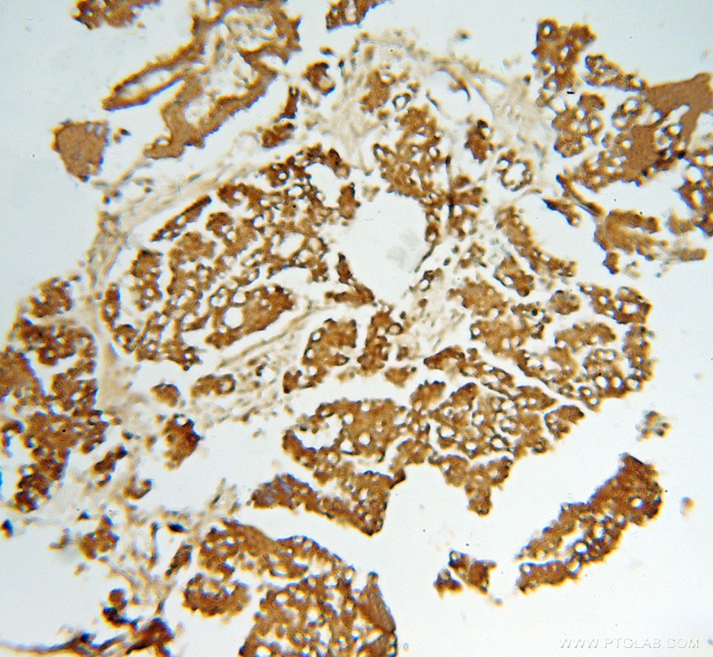 Immunohistochemistry (IHC) staining of human ovary tumor tissue using CAPZA1 Polyclonal antibody (11806-1-AP)