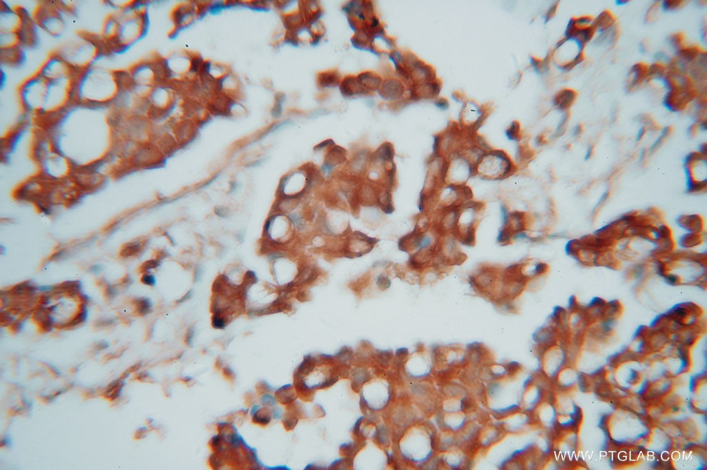 Immunohistochemistry (IHC) staining of human ovary tumor tissue using CAPZA1 Polyclonal antibody (11806-1-AP)