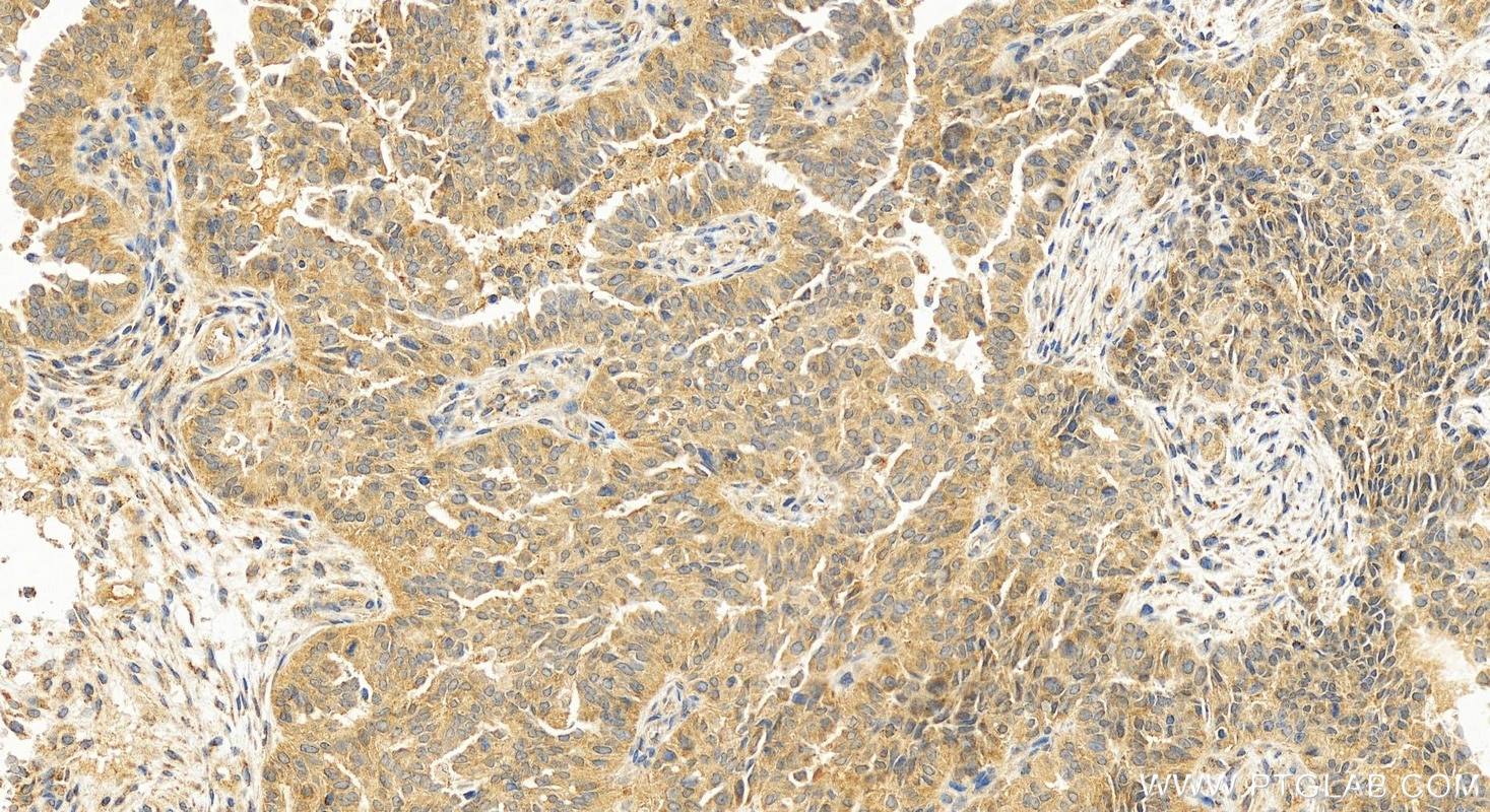 Immunohistochemical analysis of paraffin-embedded human ovarian cancer slide using 11806-1-AP (CAPZA1 antibody) at dilution of 1:200 (under 20x lens). Heat mediated antigen retrieval with Tris-EDTA buffer (pH 9.0). Immunohistochemistry (IHC) staining of human ovarian cancer using CAPZA1 Polyclonal antibody (11806-1-AP)