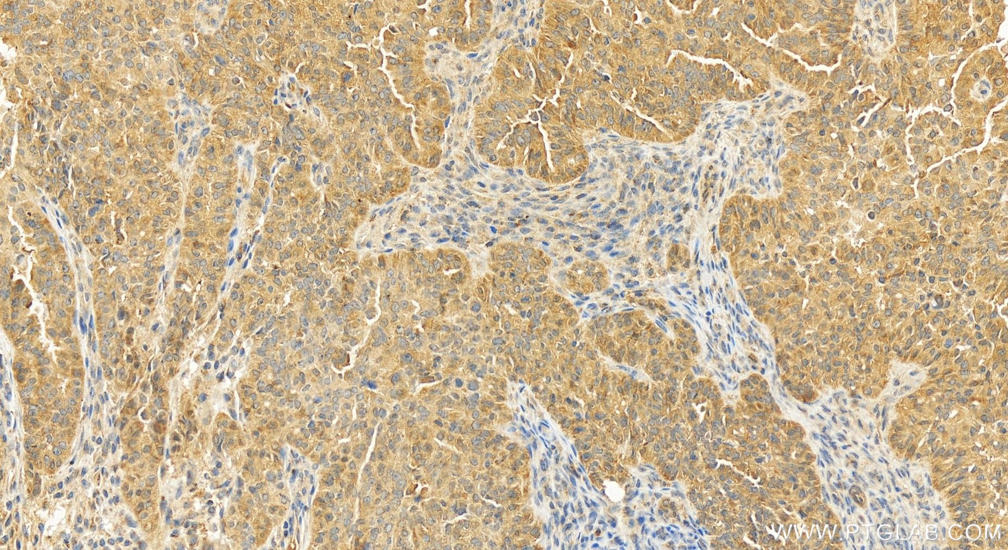 Immunohistochemical analysis of paraffin-embedded human ovarian cancer slide using 11806-1-AP (CAPZA1 antibody) at dilution of 1:200 (under 20x lens). Heat mediated antigen retrieval with Tris-EDTA buffer (pH 9.0). Immunohistochemistry (IHC) staining of human ovarian cancer using CAPZA1 Polyclonal antibody (11806-1-AP)