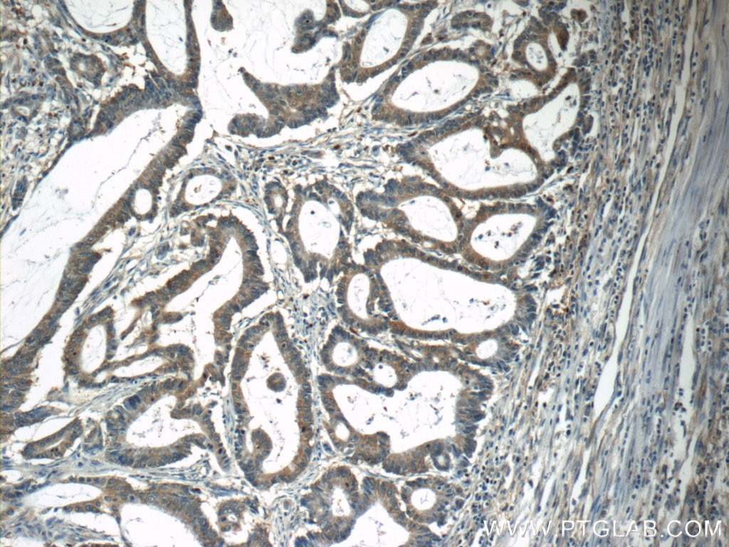 Immunohistochemistry (IHC) staining of human colon cancer tissue using CAPZA1 Polyclonal antibody (55145-1-AP)