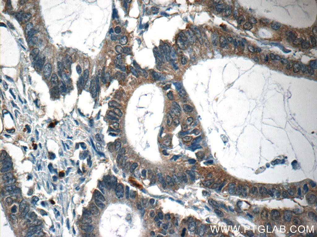 IHC staining of human colon cancer using 55145-1-AP