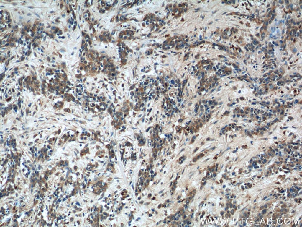 Immunohistochemistry (IHC) staining of human stomach cancer tissue using CAPZA1 Polyclonal antibody (55145-1-AP)