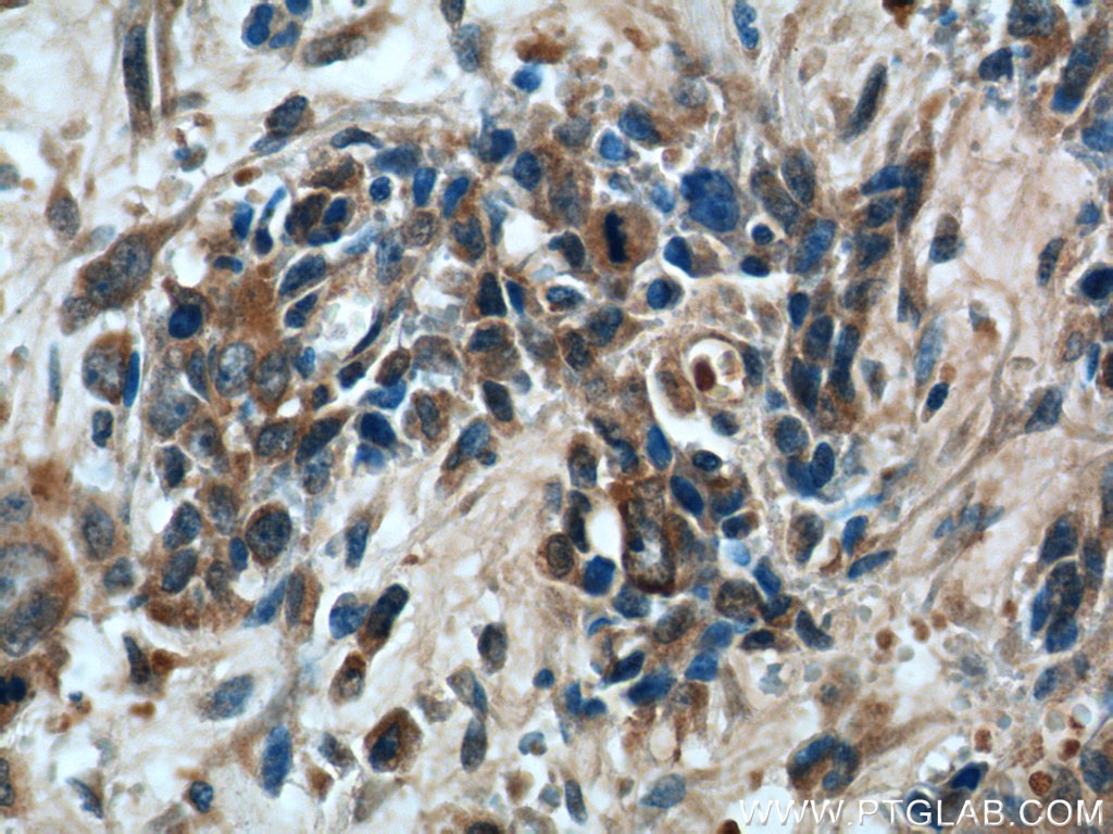 Immunohistochemistry (IHC) staining of human stomach cancer tissue using CAPZA1 Polyclonal antibody (55145-1-AP)