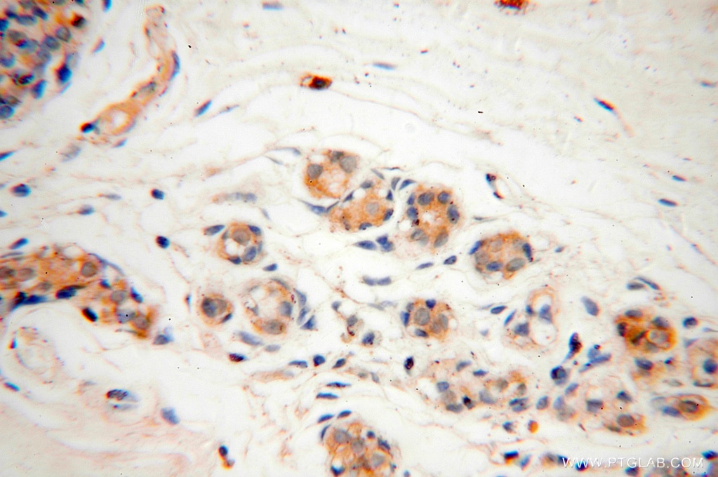 Immunohistochemistry (IHC) staining of human colon cancer tissue using CAPZA2 Polyclonal antibody (15948-1-AP)