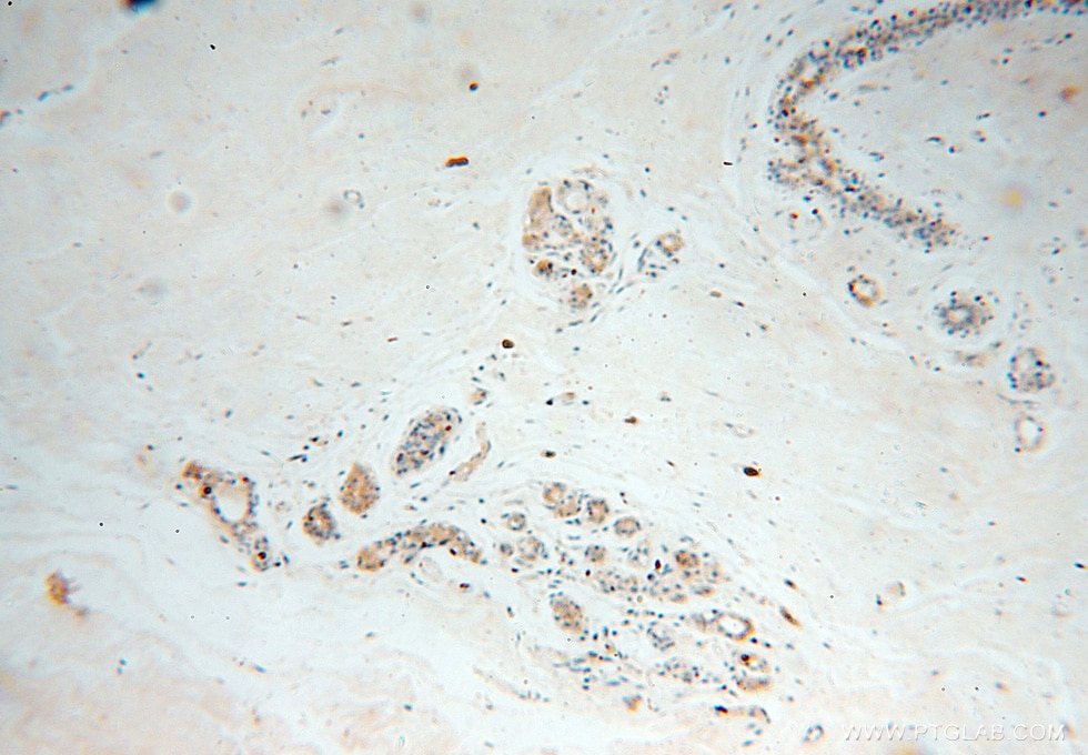 Immunohistochemistry (IHC) staining of human colon cancer tissue using CAPZA2 Polyclonal antibody (15948-1-AP)