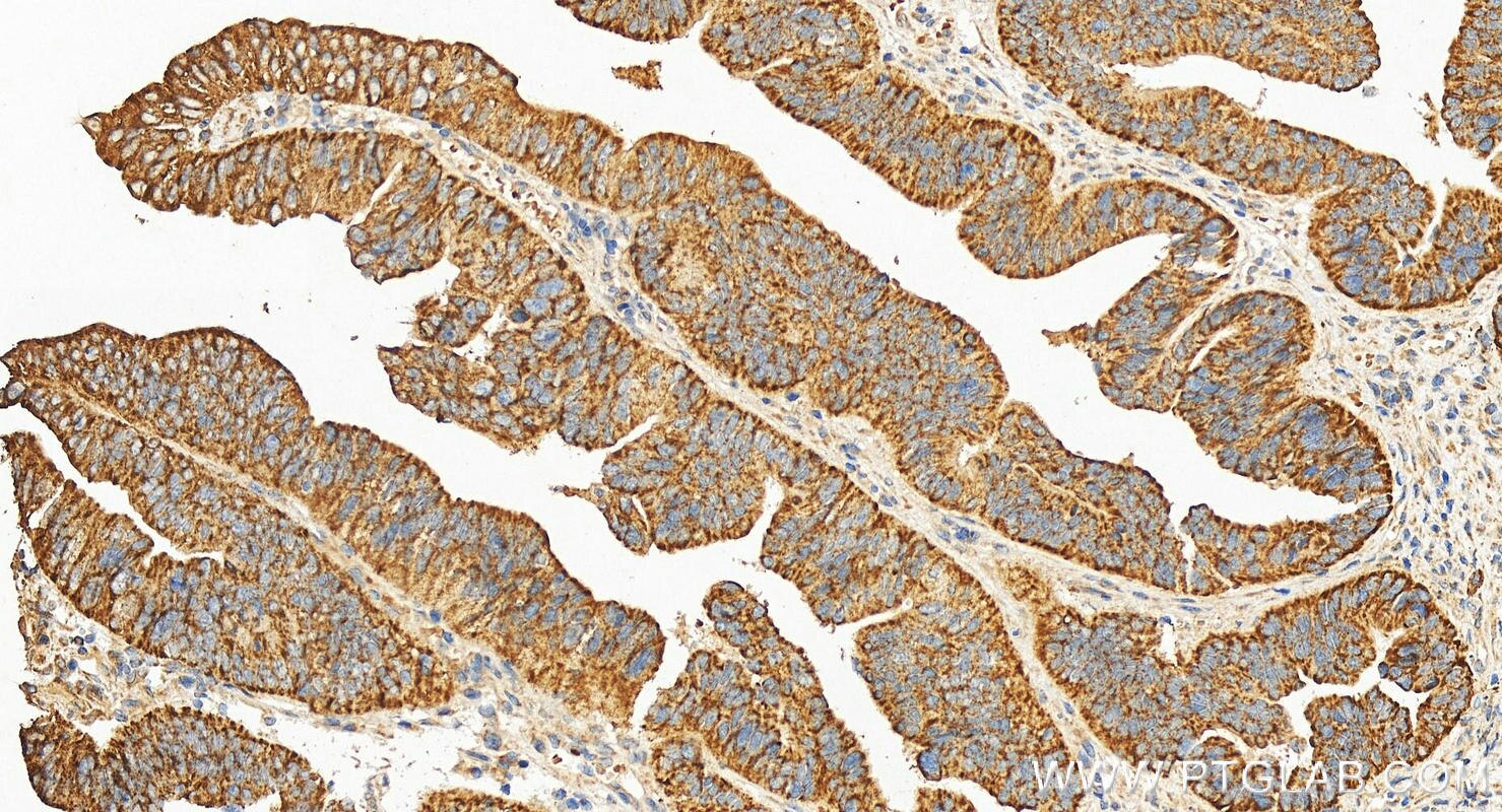 Immunohistochemistry (IHC) staining of human colon cancer tissue using CARD10 Polyclonal antibody (32374-1-AP)