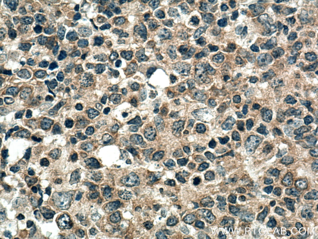 Immunohistochemistry (IHC) staining of human lymphoma tissue using CARD11 Polyclonal antibody (21741-1-AP)