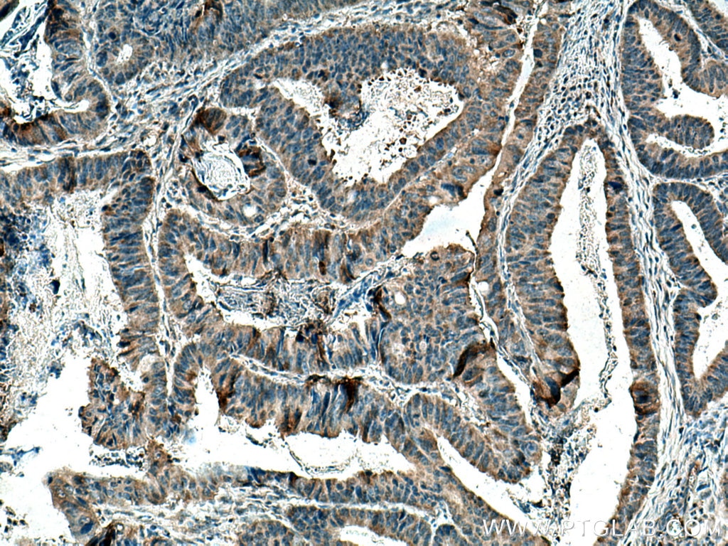 Immunohistochemistry (IHC) staining of human colon cancer tissue using CARD11 Polyclonal antibody (21741-1-AP)