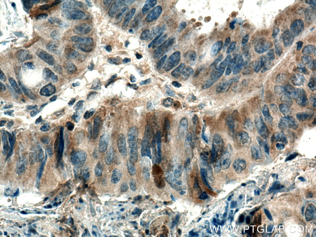 Immunohistochemistry (IHC) staining of human colon cancer tissue using CARD11 Polyclonal antibody (21741-1-AP)